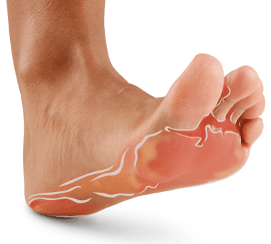 Are You Genetically Inclined to Get Athlete's Foot?