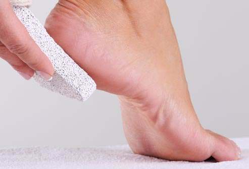 When to Visit a Podiatrist to Treat Cracked Heels